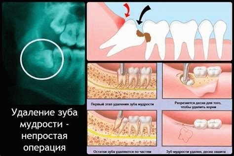 Операция по удалению лежащей восьмерки: особенности и последствия